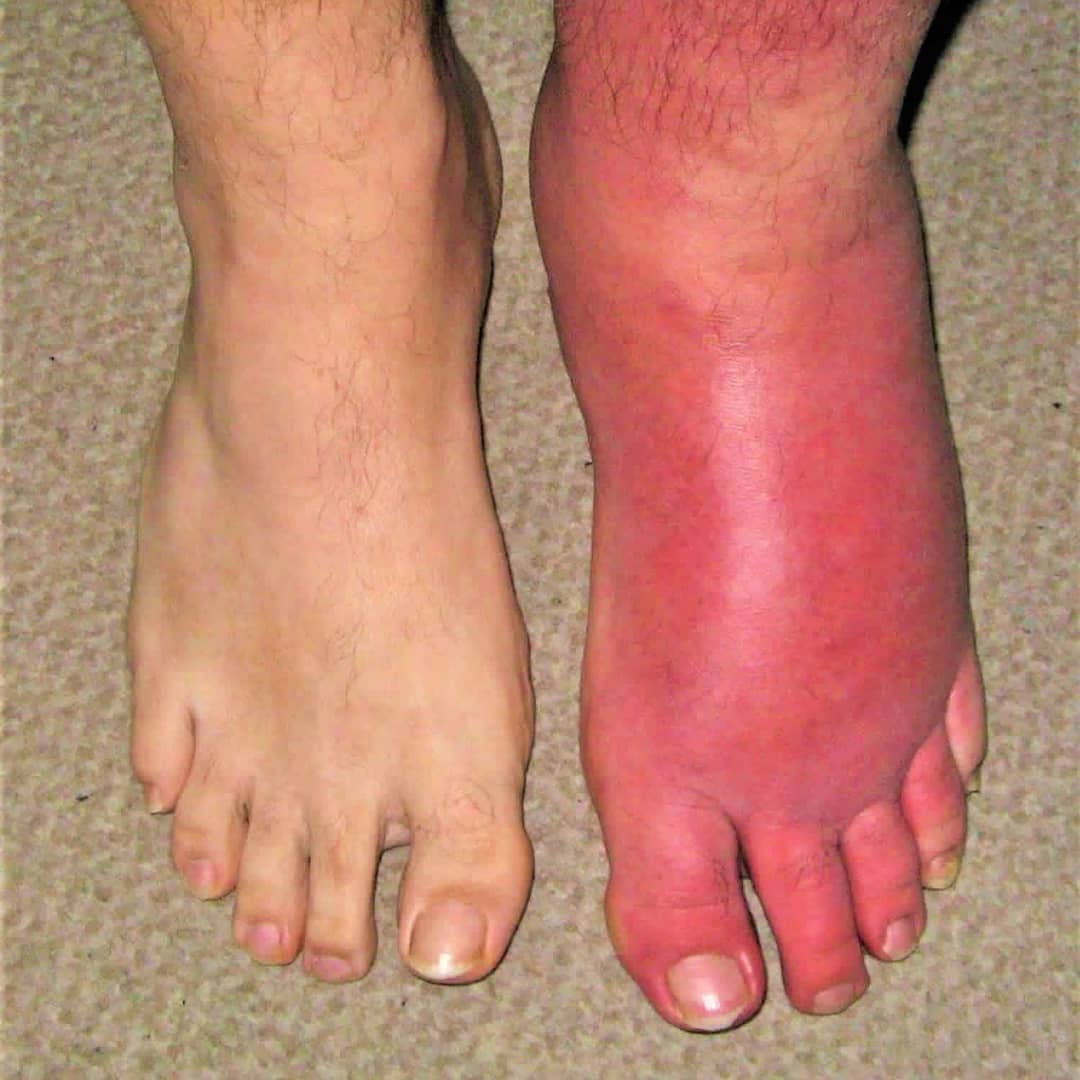 Cellulitis – What is it?